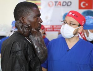 Ugandalı Muhammed’i, yüzündeki 5 kiloluk kitleden Türk doktorları kurtardı