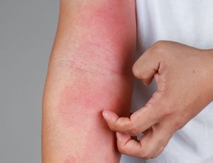 15 dakikada bulaşıp, yayılıyor! Kalabalık alanlar riskli: Gece aniden gelen kaşıntıyı hafife almayın