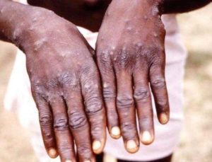 Afrika’da M çiçeğinden ölenlerin sayısı 1100’e çıktı