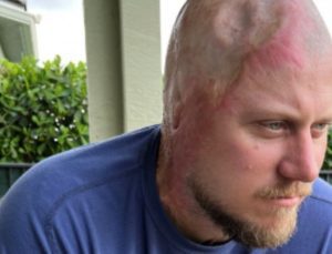 ABD’de elektrik akımına kapılan madencinin kafatası eridi