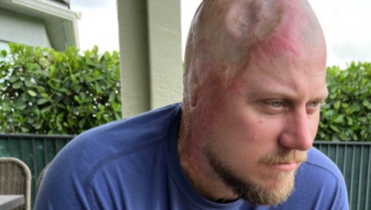 ABD’de elektrik akımına kapılan madencinin kafatası eridi