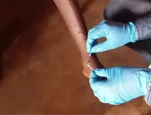 DSÖ, Maymun Çiçeği Hastalığına Karşı Aşıyı Onayladı