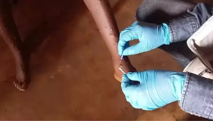 DSÖ, Maymun Çiçeği Hastalığına Karşı Aşıyı Onayladı