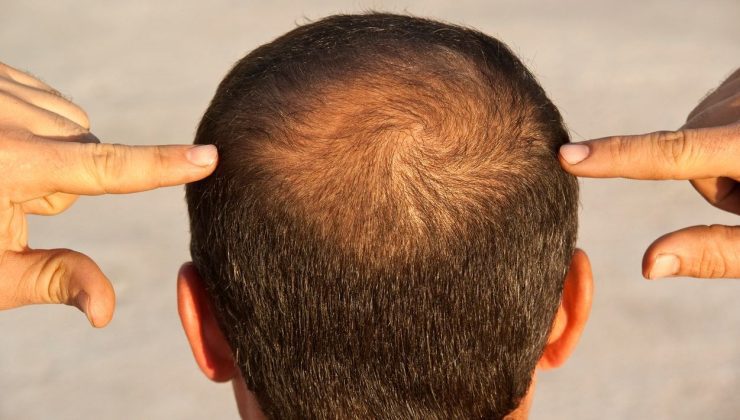 Erken yaşta kellik neden olur? 20’li saçlarda saç dökülmesin, “genetik” deyip oluruna bırakmayın