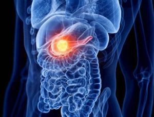 Pankreas Kanseri Tedavisinde Yenilikçi Yaklaşım