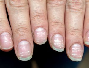 Tırnağınızdaki beyaz lekeler bu hastalığı habercisi: Zaman kaybetmeden doktora koşun