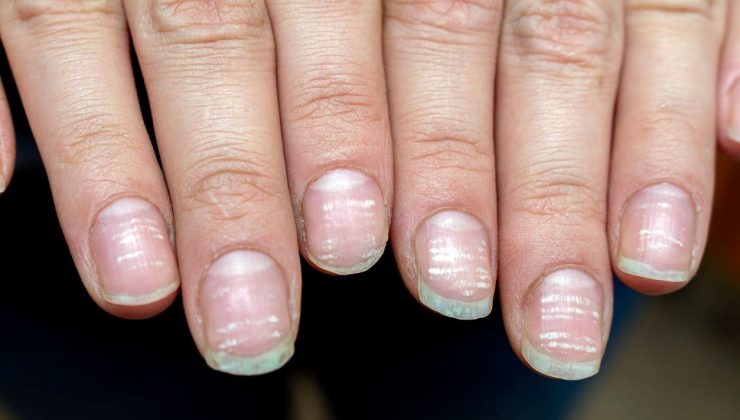 Tırnağınızdaki beyaz lekeler bu hastalığı habercisi: Zaman kaybetmeden doktora koşun