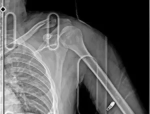 Esenyurt’ta otomobilin çarptığı motosikletli kurye: Kaçan sürücü beni ölüme terk etti