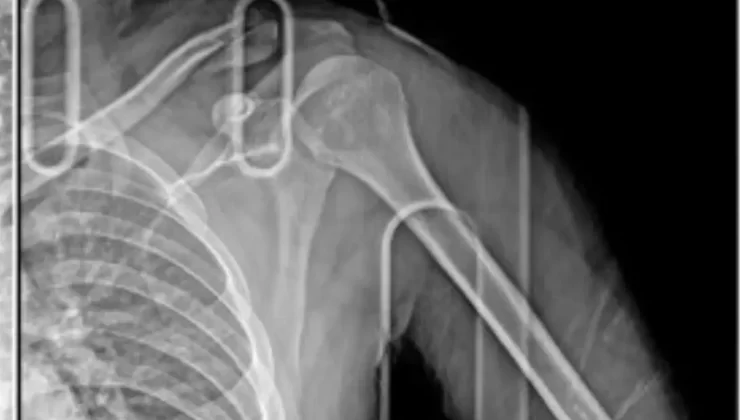 Esenyurt’ta otomobilin çarptığı motosikletli kurye: Kaçan sürücü beni ölüme terk etti