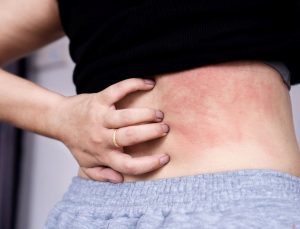 19 yaşındaki genç kızın hayatı kâbusa döndü: Bu besinleri yiyemiyor, yağmur bile tehlikeli; Su içebiliyor lakin temas edemiyor