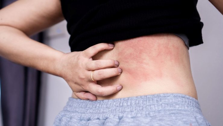 19 yaşındaki genç kızın hayatı kâbusa döndü: Bu besinleri yiyemiyor, yağmur bile tehlikeli; Su içebiliyor lakin temas edemiyor