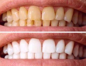 Diş taşı paklığında bilinmesi gerekenler: Enfeksiyona neden olur mu