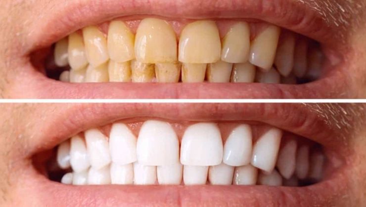 Diş taşı paklığında bilinmesi gerekenler: Enfeksiyona neden olur mu