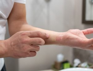 Gerilime bağlı 5 cilt hastalığı: Cilt bariyerini zayıflatıp iltihabı tetikliyor