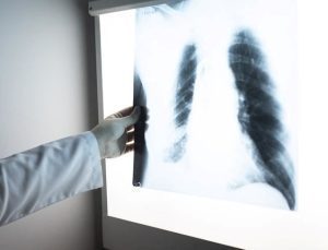 Kanserde tehlikeli artış: Sigara içmeyenlerde de artıyor!