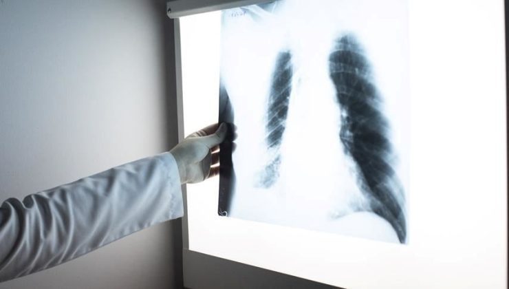 Kanserde tehlikeli artış: Sigara içmeyenlerde de artıyor!