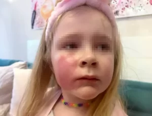 Öptüğü kızının yanağı yandı: Benim hatamı yapmayın