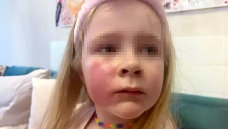 Öptüğü kızının yanağı yandı: Benim hatamı yapmayın