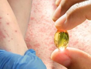 Kızamık vakaları artmaya başladı: A vitamini çözüm mü sunuyor? Araştırma sonuçları kafaları karıştırdı…