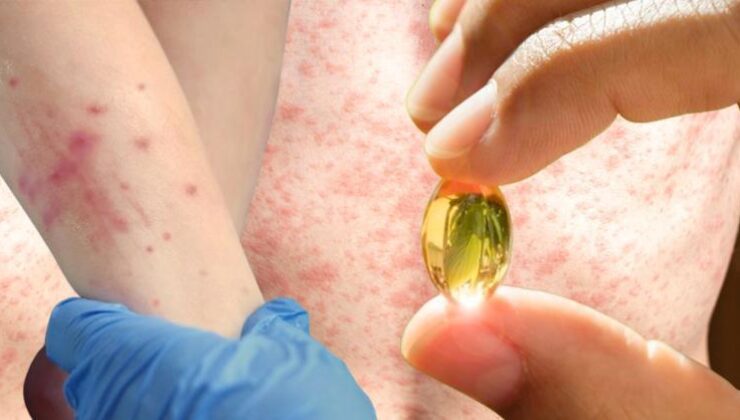 Kızamık vakaları artmaya başladı: A vitamini çözüm mü sunuyor? Araştırma sonuçları kafaları karıştırdı…